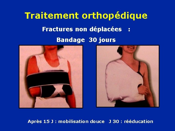 Traitement orthopédique Fractures non déplacées : Bandage 30 jours Après 15 J : mobilisation