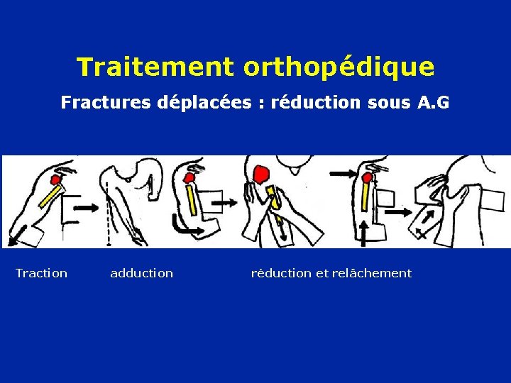 Traitement orthopédique Fractures déplacées : réduction sous A. G Traction adduction réduction et relâchement