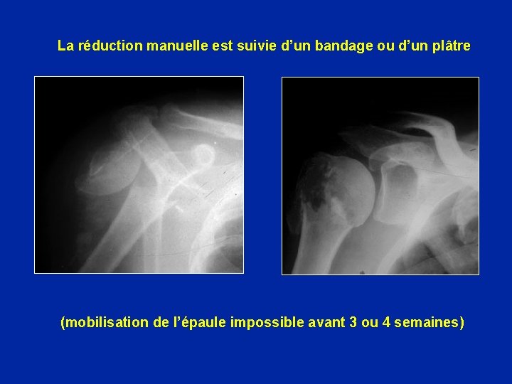 La réduction manuelle est suivie d’un bandage ou d’un plâtre (mobilisation de l’épaule impossible