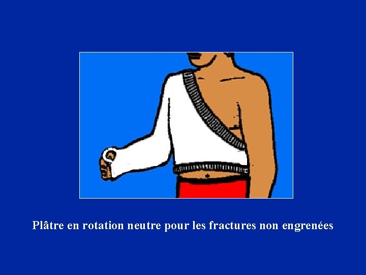 Plâtre en rotation neutre pour les fractures non engrenées 