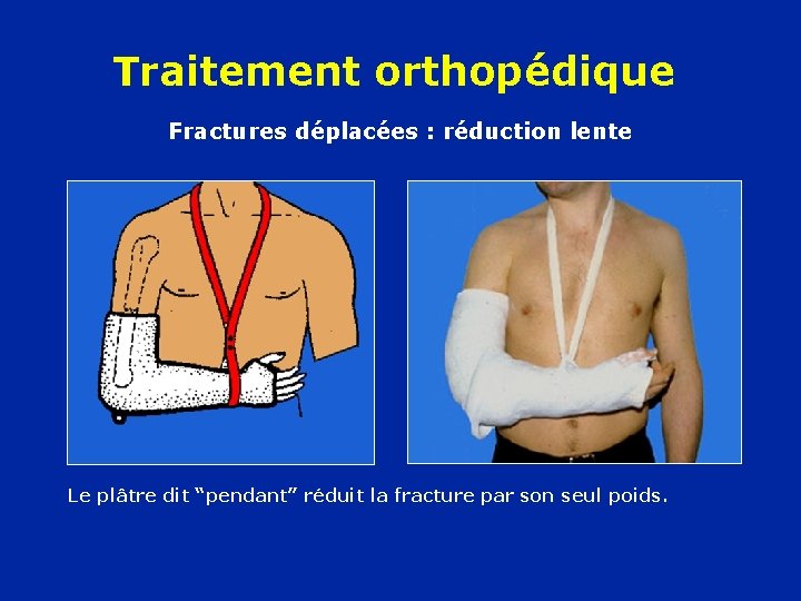 Traitement orthopédique Fractures déplacées : réduction lente Le plâtre dit “pendant” réduit la fracture