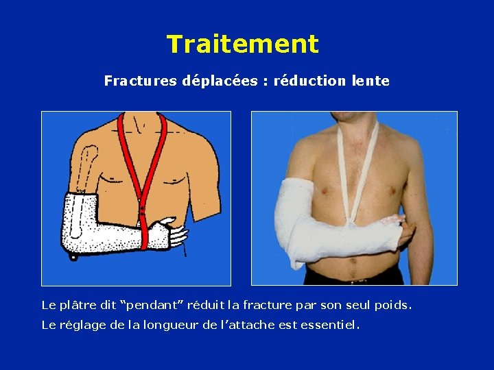 Traitement Fractures déplacées : réduction lente Le plâtre dit “pendant” réduit la fracture par