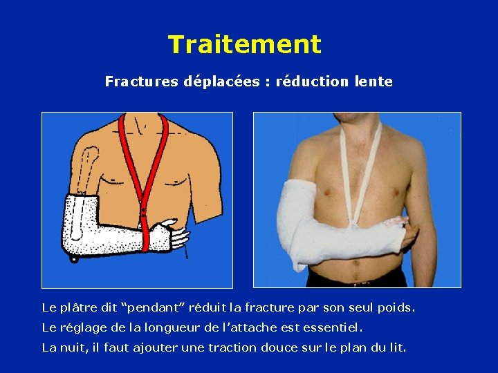 Traitement Fractures déplacées : réduction lente Le plâtre dit “pendant” réduit la fracture par