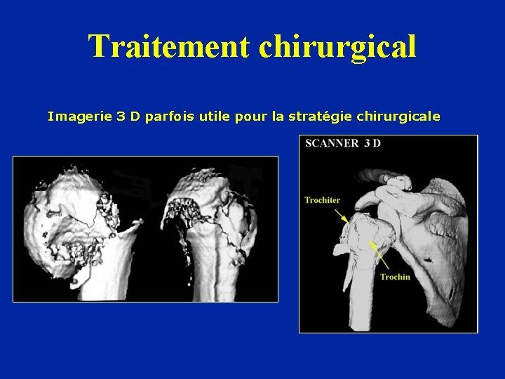 Traitement chirurgical Imagerie 3 D parfois utile pour la stratégie chirurgicale 