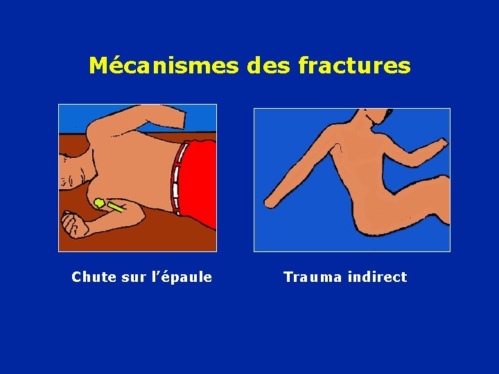 Mécanismes des fractures Chute sur l’épaule Trauma indirect 