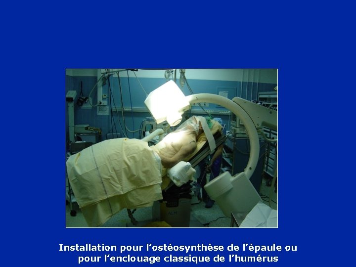 Installation pour l’ostéosynthèse de l’épaule ou pour l’enclouage classique de l’humérus 