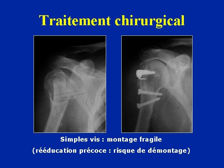 Traitement chirurgical Simples vis : montage fragile (rééducation précoce : risque de démontage) 