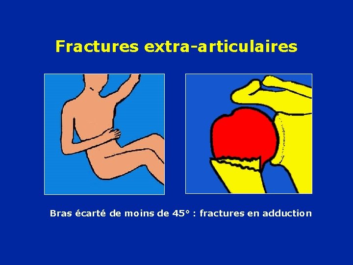 Fractures extra-articulaires Bras écarté de moins de 45° : fractures en adduction 