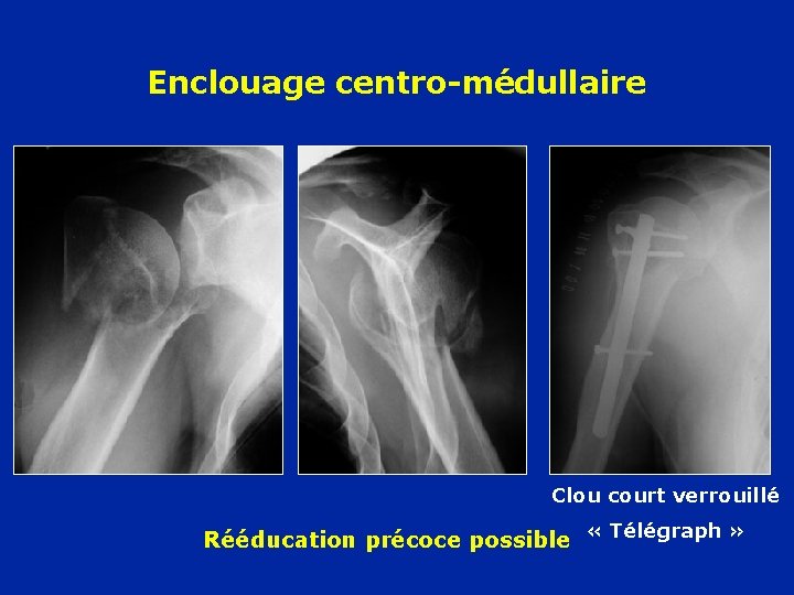 Enclouage centro-médullaire Clou court verrouillé Rééducation précoce possible « Télégraph » 