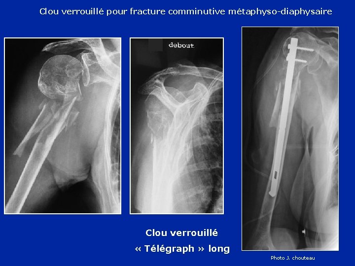 Clou verrouillé pour fracture comminutive métaphyso-diaphysaire Clou verrouillé « Télégraph » long Photo J.