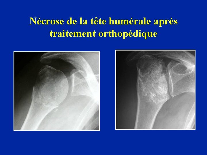 Nécrose de la tête humérale après traitement orthopédique 