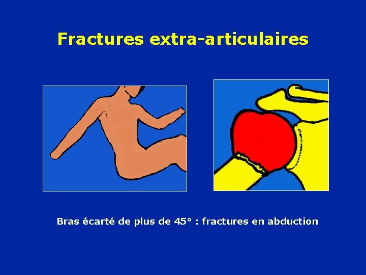 Fractures extra-articulaires Bras écarté de plus de 45° : fractures en abduction 