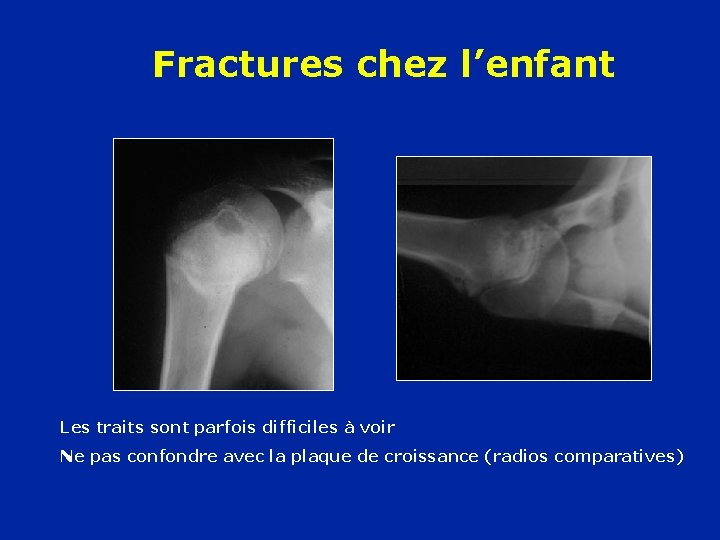 Fractures chez l’enfant Les traits sont parfois difficiles à voir Ne pas confondre avec