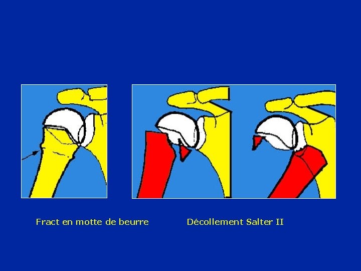 Fract en motte de beurre Décollement Salter II 