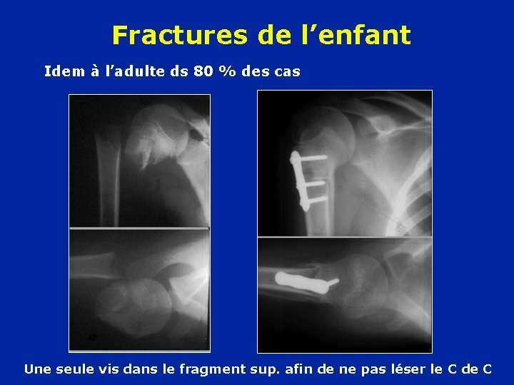 Fractures de l’enfant Idem à l’adulte ds 80 % des cas Une seule vis