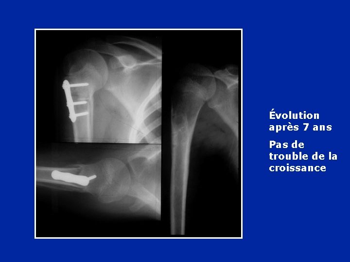 Évolution après 7 ans Pas de trouble de la croissance 