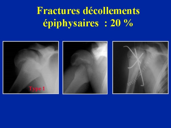 Fractures décollements épiphysaires : 20 % Type 1 