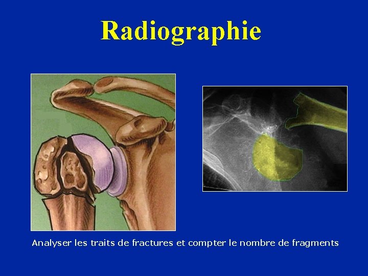 Radiographie Analyser les traits de fractures et compter le nombre de fragments 