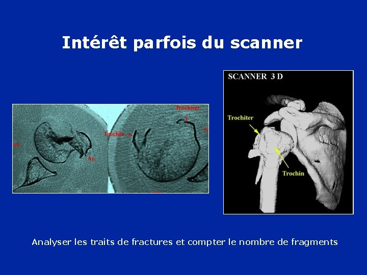 Intérêt parfois du scanner Analyser les traits de fractures et compter le nombre de