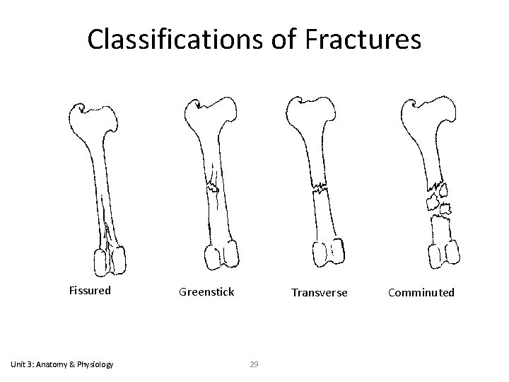 Classifications of Fractures Fissured Unit 3: Anatomy & Physiology Greenstick Transverse 29 Comminuted 
