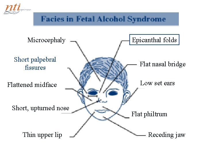 Epicanthal folds Microcephaly Short palpebral fissures Flat nasal bridge Low set ears Flattened midface