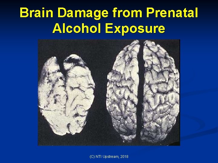 Brain Damage from Prenatal Alcohol Exposure (C) NTI Upstream, 2018 