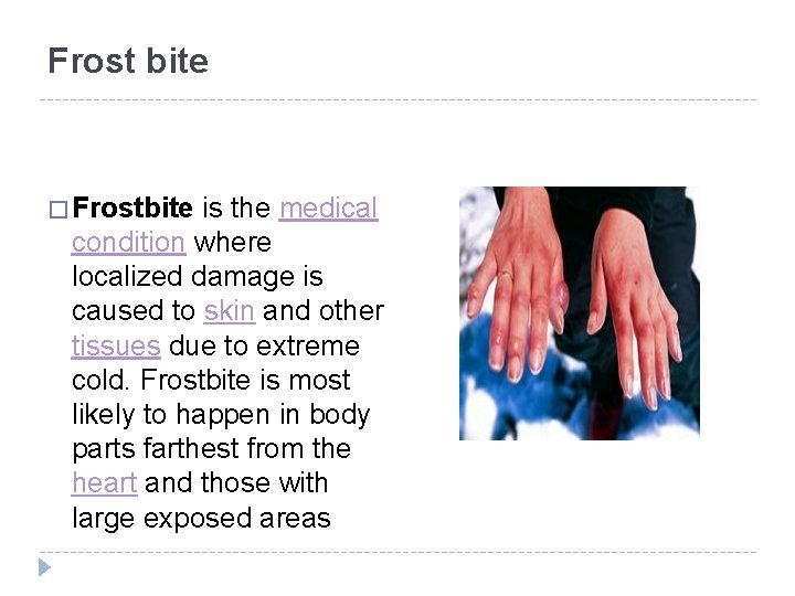 Frost bite � Frostbite is the medical condition where localized damage is caused to Frost bite � Frostbite is the medical condition where localized damage is caused to
