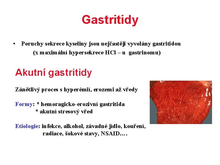 Gastritidy • Poruchy sekrece kyseliny jsou nejčastěji vyvolány gastritidou (x maximální hypersekrece HCl –