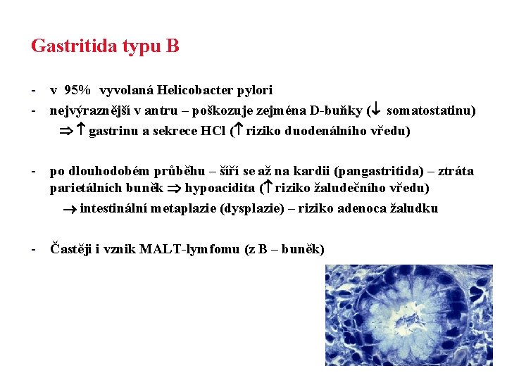 Gastritida typu B - v 95% vyvolaná Helicobacter pylori - nejvýraznější v antru –