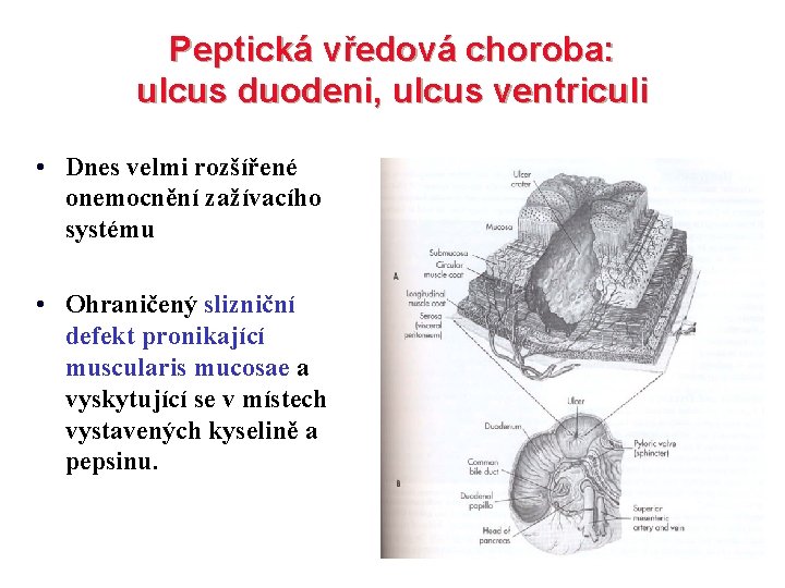 Peptická vředová choroba: ulcus duodeni, ulcus ventriculi • Dnes velmi rozšířené onemocnění zažívacího systému