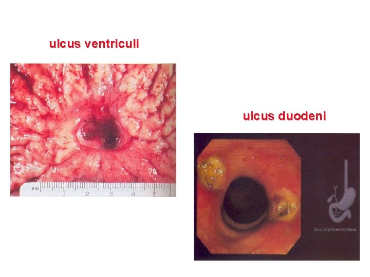 ulcus ventriculi ulcus duodeni 