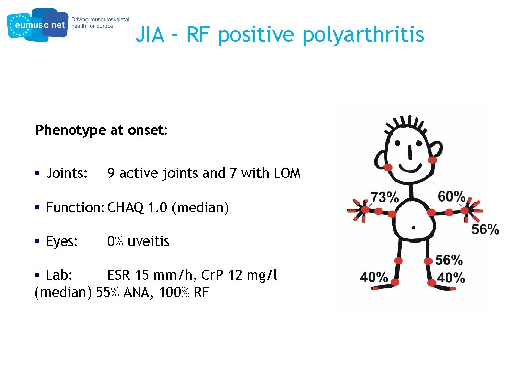 JIA - RF positive polyarthritis Phenotype at onset: § Joints: 9 active joints and