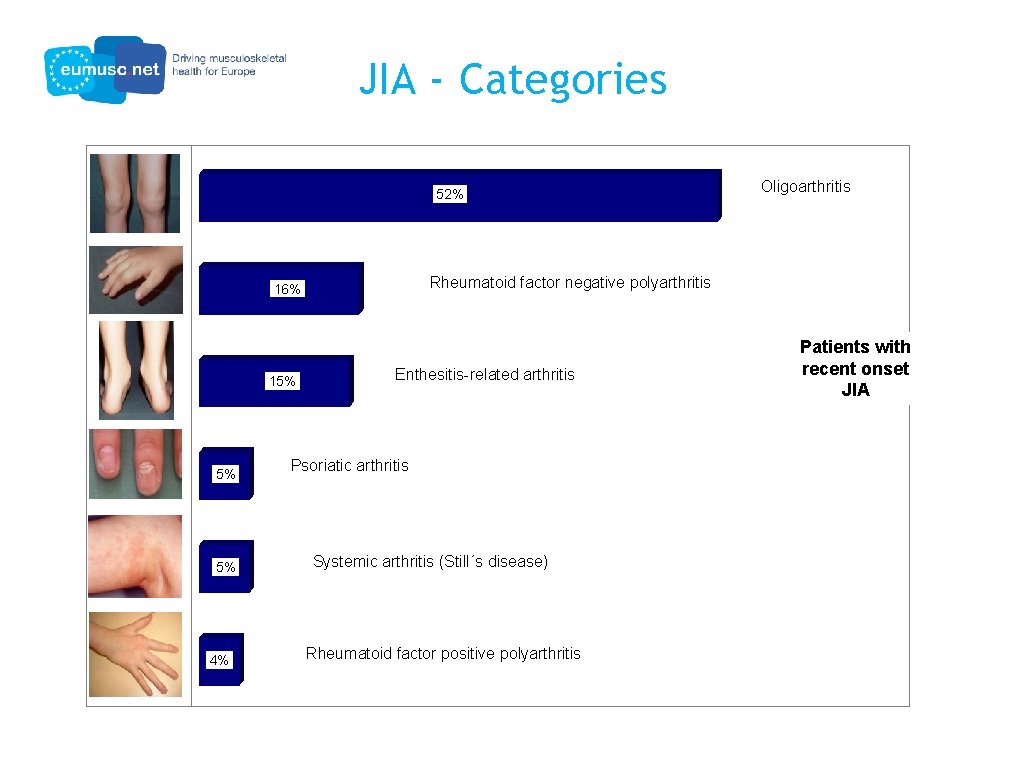 JIA - Categories 52% Rheumatoid factor negative polyarthritis 16% 15% 5% 5% 4% Oligoarthritis