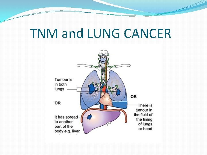TNM and LUNG CANCER 