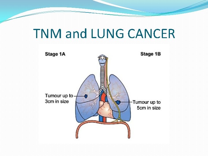 TNM and LUNG CANCER 