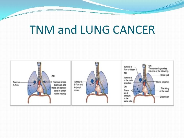 TNM and LUNG CANCER 