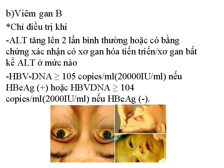 b)Viêm gan B *Chỉ điều trị khi -ALT tăng lên 2 lần bình thường