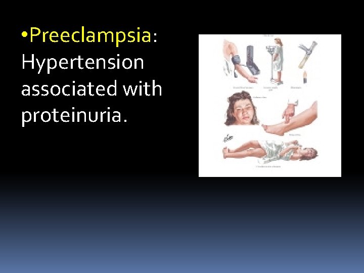  • Preeclampsia: Hypertension associated with proteinuria. 