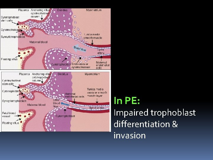 In PE: Impaired trophoblast differentiation & invasion 