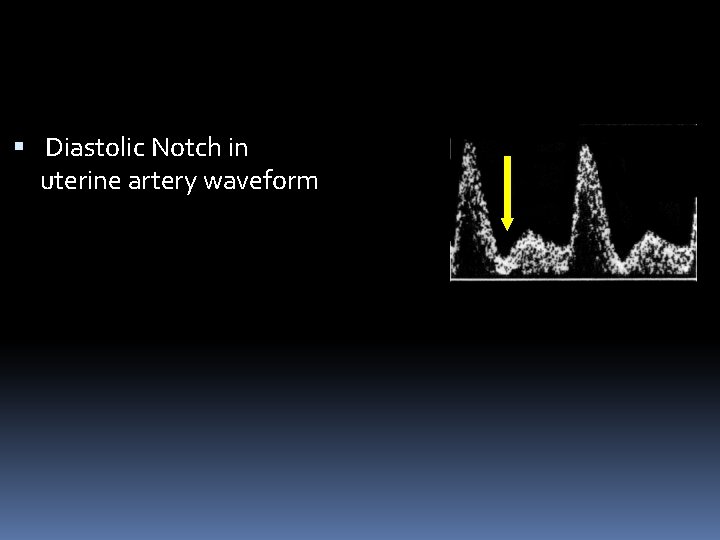  Diastolic Notch in uterine artery waveform 