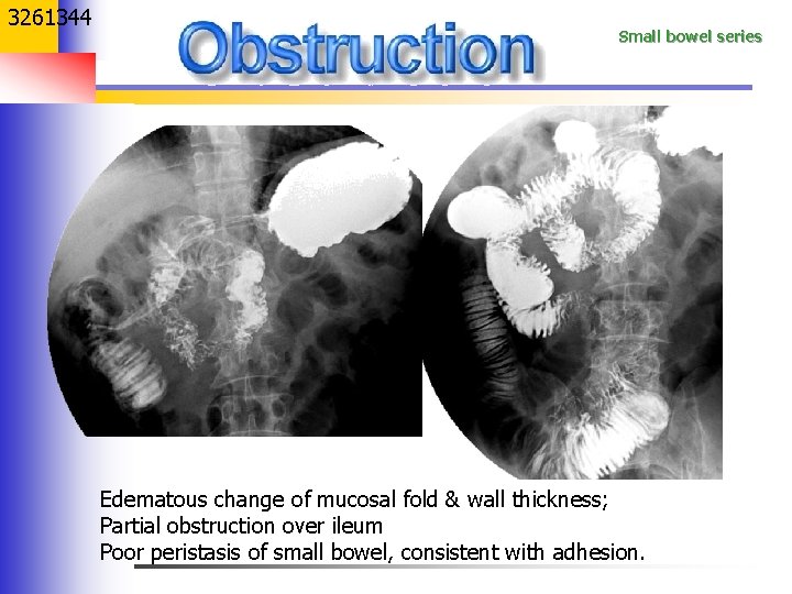3261344 Small bowel series Edematous change of mucosal fold & wall thickness; Partial obstruction