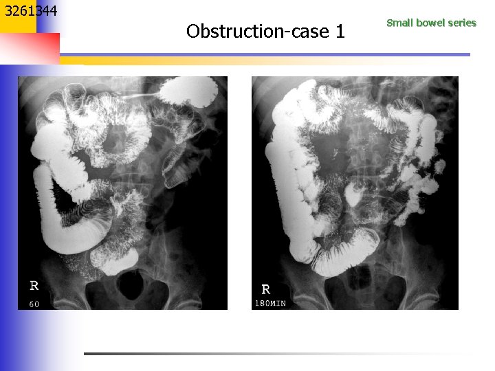 3261344 Obstruction-case 1 Small bowel series 
