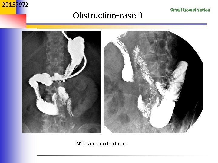 20157972 Obstruction-case 3 NG placed in duodenum Small bowel series 