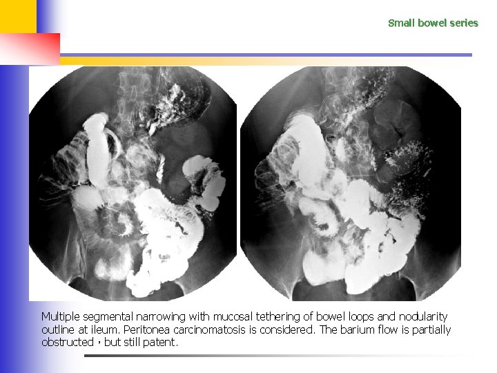 Small bowel series Multiple segmental narrowing with mucosal tethering of bowel loops and nodularity