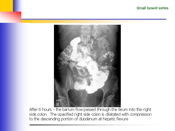 Small bowel series After 6 hours，the barium flow passed through the ileum into the