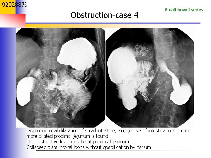 92028879 Obstruction-case 4 Small bowel series Disproportional dilatation of small intestine, suggestive of intestinal