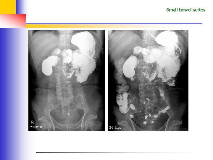 Small bowel series 