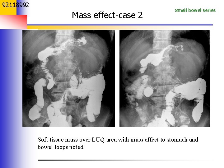 92118992 Mass effect-case 2 Small bowel series Soft tissue mass over LUQ area with