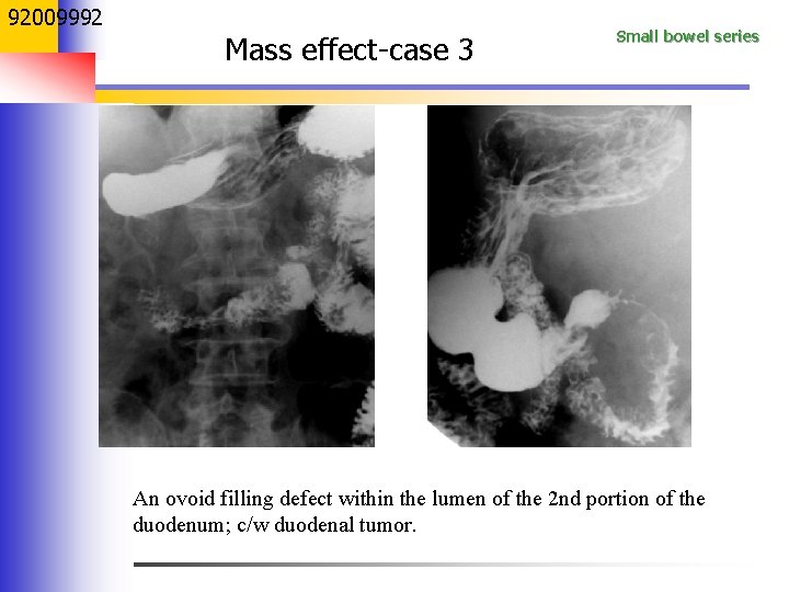 92009992 Mass effect-case 3 Small bowel series An ovoid filling defect within the lumen