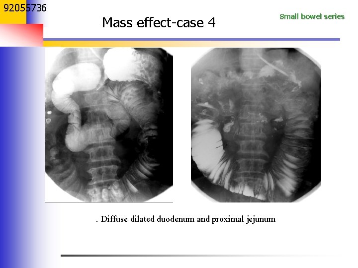 92055736 Mass effect-case 4 . Diffuse dilated duodenum and proximal jejunum Small bowel series